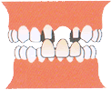 前歯部一本欠損の場合：従来の治療