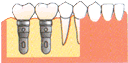 臼歯部から歯が欠損している場合（遊離端）：インプラント治療